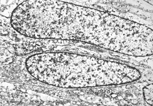 F,56y. | diffuse peritoneal leiomyomatosis